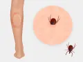 Noga z rumieniem po ukąszeniu kleszcza i zbliżenie na kleszcza wbitego w skórę.