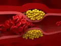 Zator w naczyniu krwionośnym: czerwone krwinki i żółte złogi. Badanie lipoproteiny pomoże ocenić ryzyko.