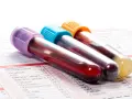 Trzy probówki z krwią na tle formularza laboratoryjnego z listą badań, w tym CRP.