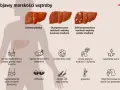 Ilustracja przedstawia objawy marskości wątroby: ból brzucha, zmęczenie, utratę masy ciała, żółtaczkę, obrzęki, gorączkę i zmiany skórne.