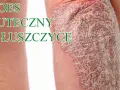 Czy jest nowy lek na łuszczycę? Odkryj najnowsze terapie i ich skuteczność