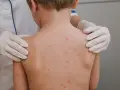 Skuteczne leki na ospę wietrzną: jak złagodzić objawy i ból