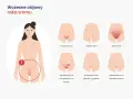 Ilustracja pokazuje wczesne objawy raka sromu: świąd, dyskomfort, pieczenie, zgrubienia, owrzodzenia, grudki i guzki.