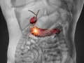 Anatomical illustration of a human torso showing a red gallbladder and pancreas with a bright light emanating from the pancreas.