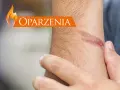 Dłoń z widocznym oparzeniem i napisem "Oparzenia".