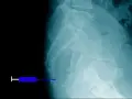 Jakie leki na ból kości ogonowej mogą naprawdę pomóc w ulgach?