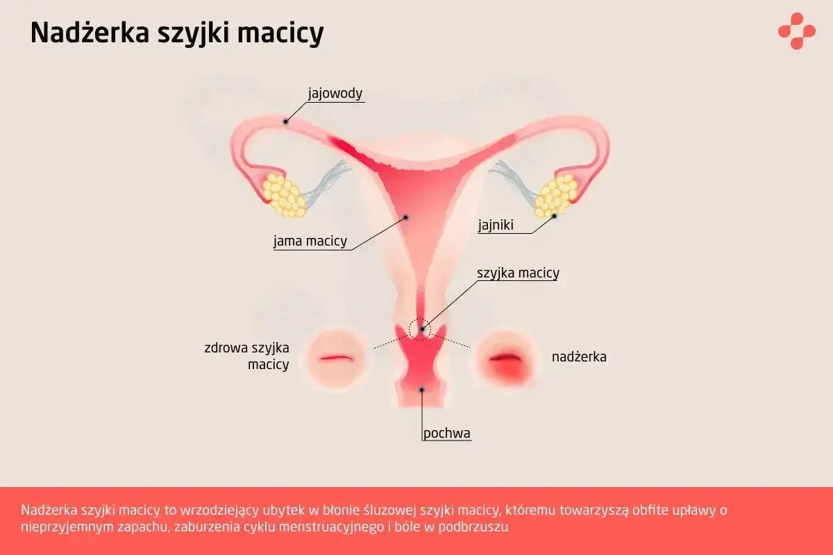 Ilustracja przedstawia budowę narządów rodnych kobiety z zaznaczoną nadżerką szyjki macicy.