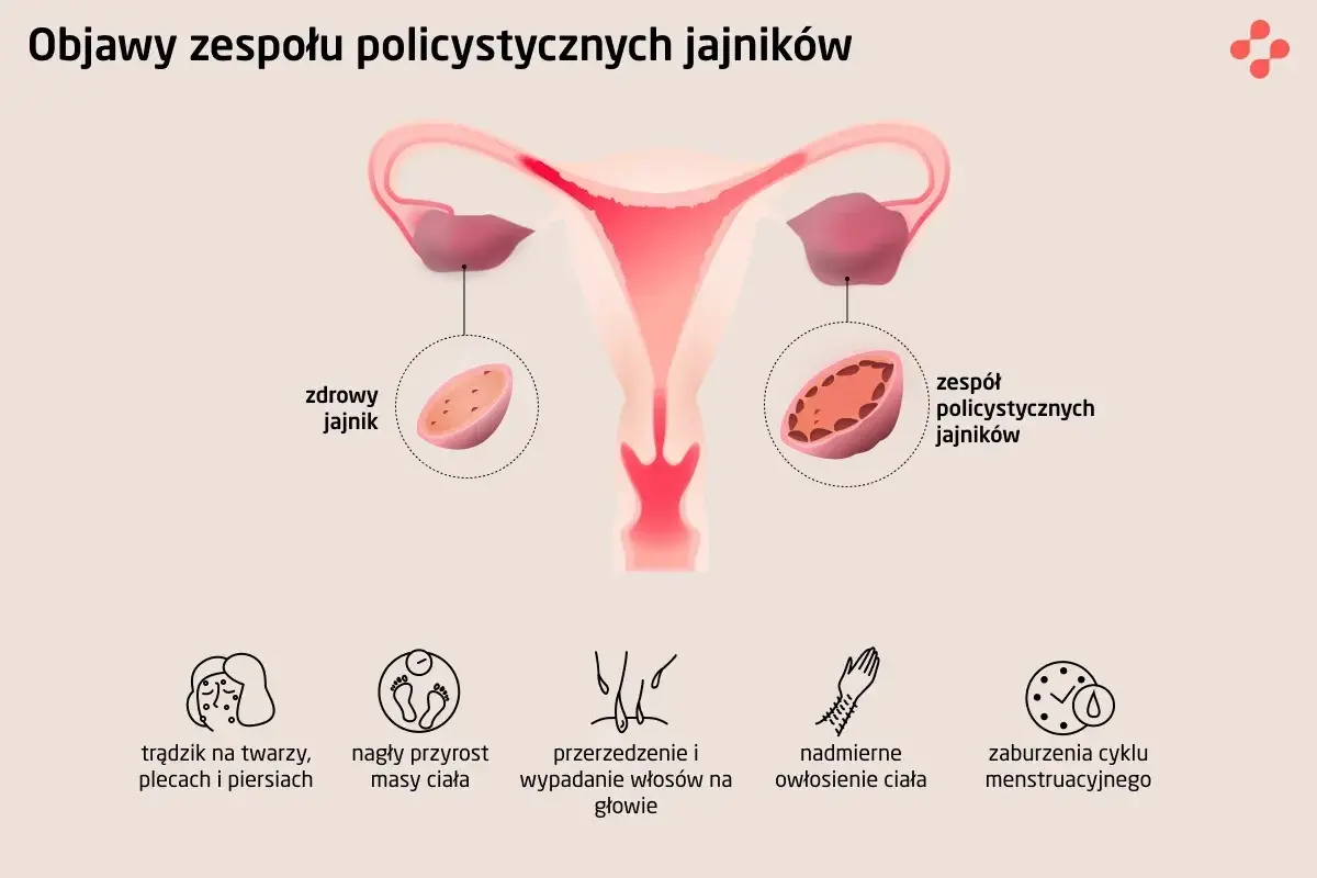 Ilustracja pokazuje budowę macicy i jajników, porównując zdrowy jajnik z tymi w zespole PCOS. Wymienia też typowe pcos objawy: trądzik, przyrost masy ciała, wypadanie włosów, nadmierne owłosienie i zaburzenia cyklu.