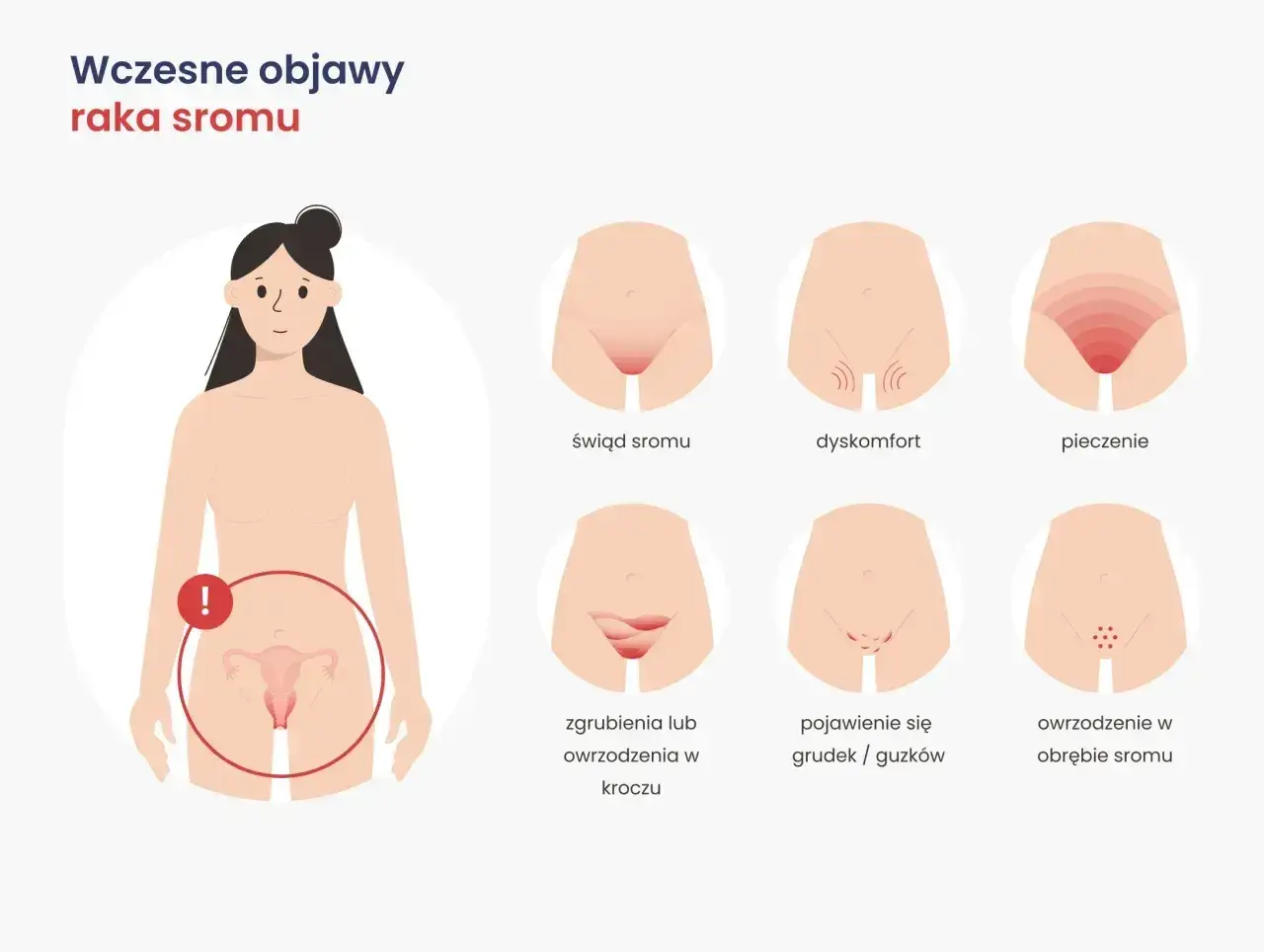 Ilustracja pokazuje wczesne objawy raka sromu: świąd, dyskomfort, pieczenie, zgrubienia, owrzodzenia, grudki i guzki.