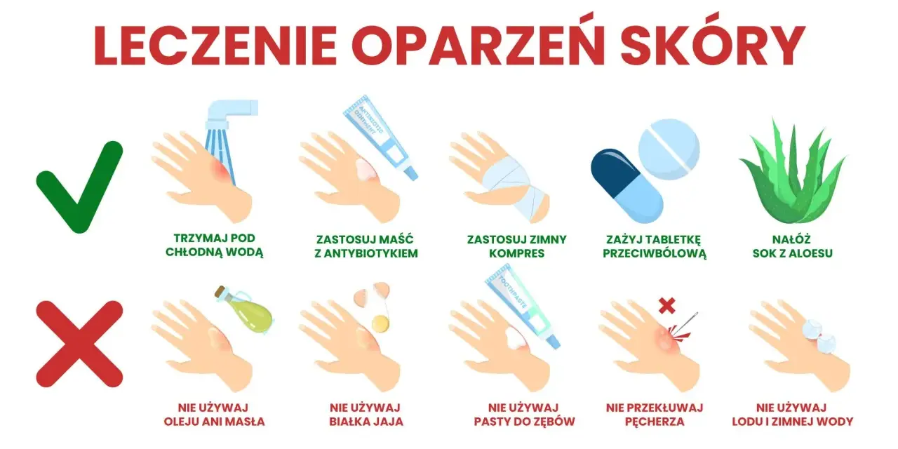 Ilustracja pokazuje leczenie oparzeń skóry: chłodna woda, maść z antybiotykiem, zimny kompres, tabletki przeciwbólowe, sok z aloesu. Unikaj masła, jajek, pasty do zębów, lodu.