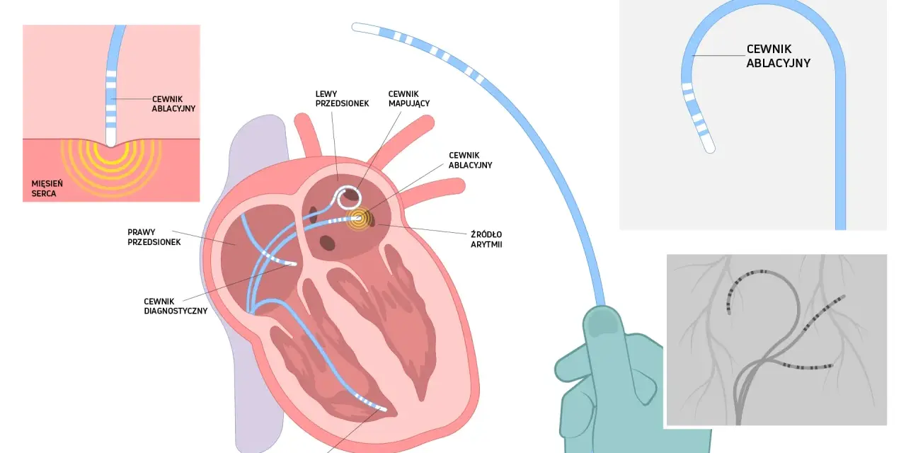 Ilustracja przedstawia schemat ablacji serca z cewnikami diagnostycznymi i ablacyjnymi w sercu.