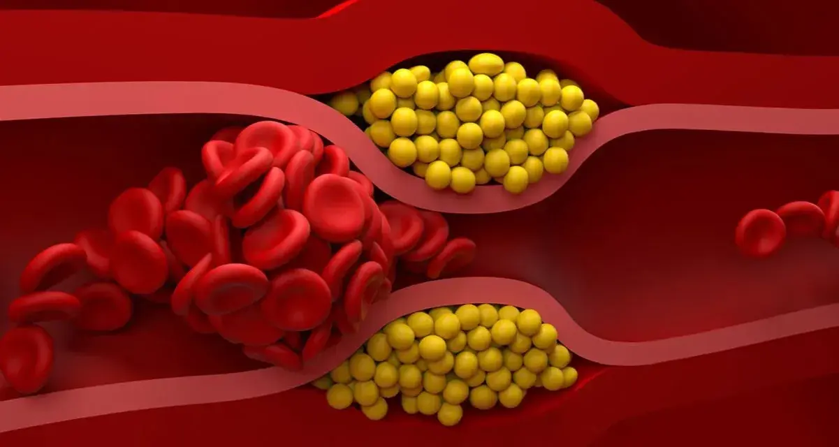 Zator w naczyniu krwionośnym: czerwone krwinki i żółte złogi. Badanie lipoproteiny pomoże ocenić ryzyko.