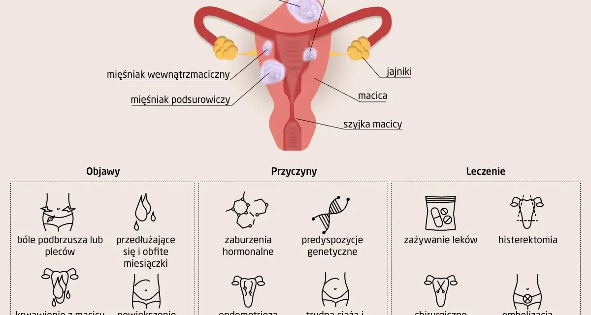 Pęknięcie mięśniaka macicy objawy: bóle brzucha, obfite miesiączki, krwawienia, powiększenie brzucha.