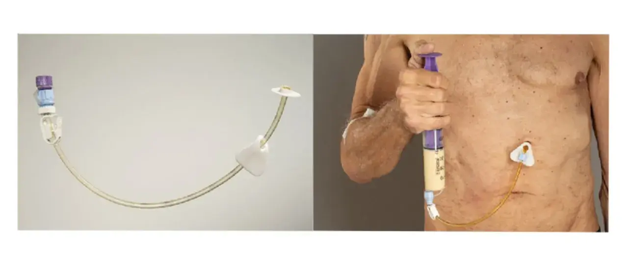 Gastrostomia endoskopowa (PEG) - przyrząd i zastosowanie.
