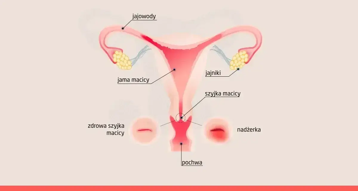 Ilustracja przedstawia budowę narządów rodnych kobiety z zaznaczoną nadżerką szyjki macicy.