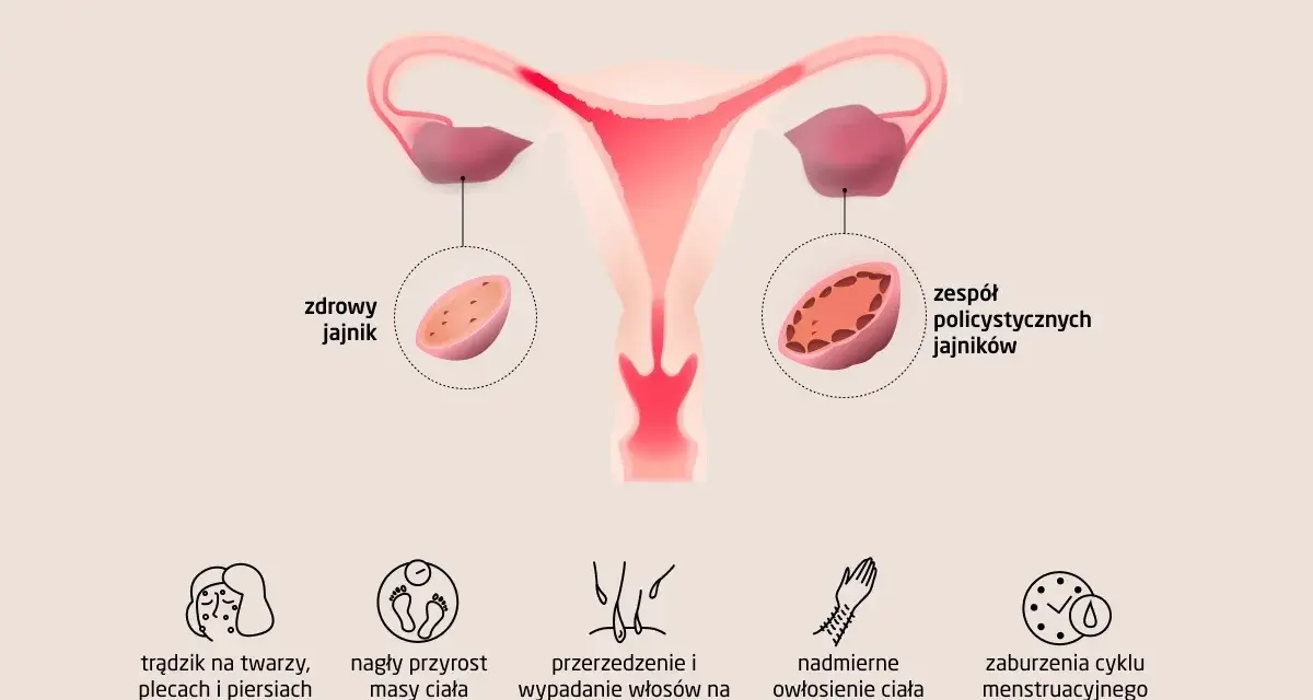 Ilustracja pokazuje budowę macicy i jajników, porównując zdrowy jajnik z tymi w zespole PCOS. Wymienia też typowe pcos objawy: trądzik, przyrost masy ciała, wypadanie włosów, nadmierne owłosienie i zaburzenia cyklu.