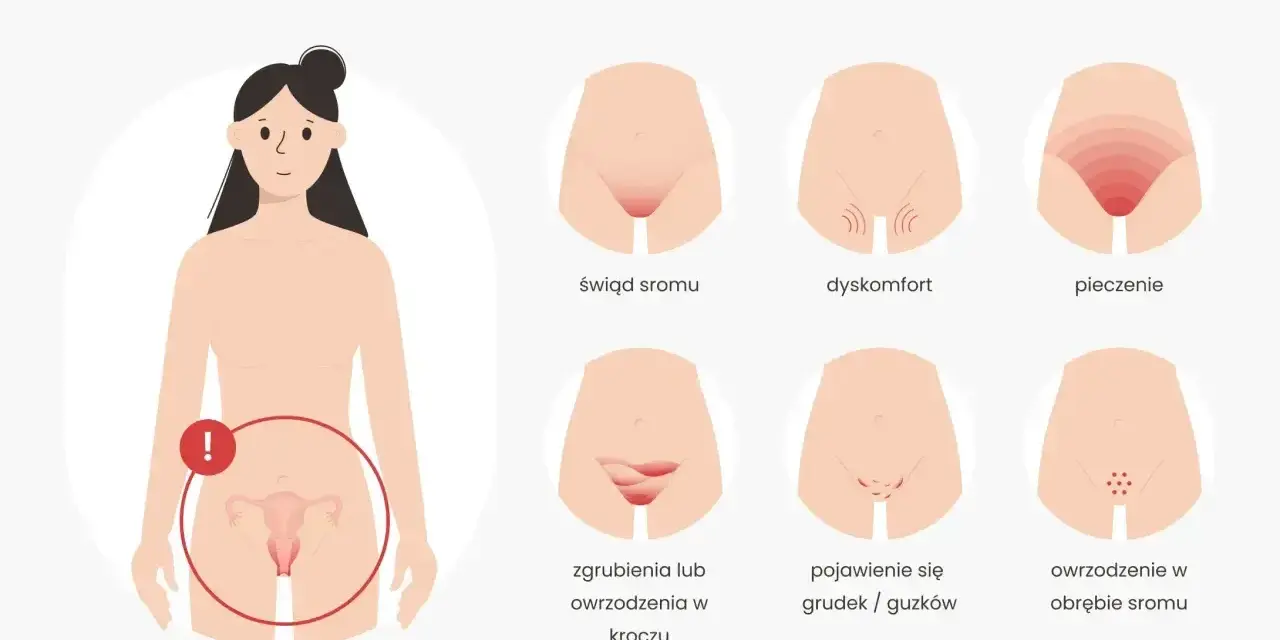 Ilustracja pokazuje wczesne objawy raka sromu: świąd, dyskomfort, pieczenie, zgrubienia, owrzodzenia, grudki i guzki.