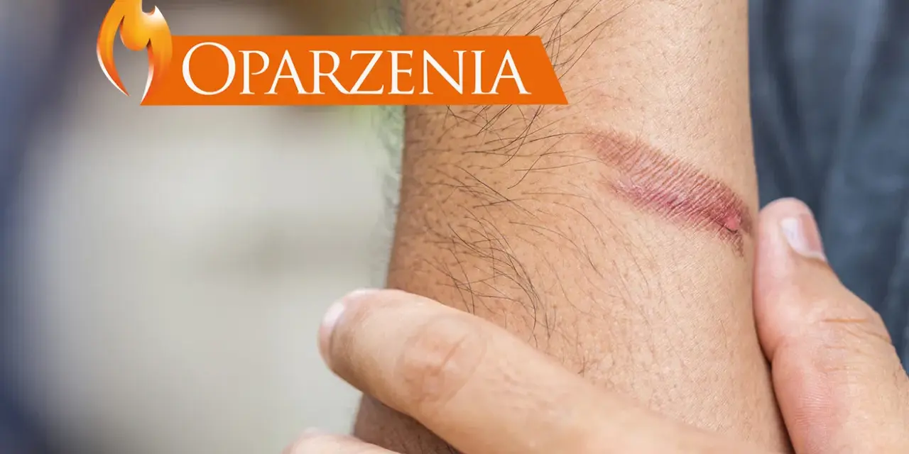 Dłoń z widocznym oparzeniem i napisem "Oparzenia".