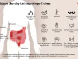 Objawy choroby Leśniowskiego-Crohna: krew w stolcu, zmęczenie, gorączka, problemy z oczami, biegunka, bóle brzucha, zapalenie skóry i stawów.