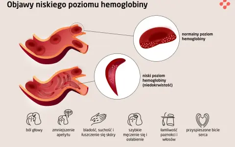 Ilustracja porównująca krwinki czerwone przy normalnym i niskim poziomie hemoglobiny, z ikonami objawów.