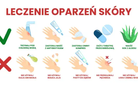 Ilustracja pokazuje leczenie oparzeń skóry: chłodna woda, maść z antybiotykiem, zimny kompres, tabletki przeciwbólowe, sok z aloesu. Unikaj masła, jajek, pasty do zębów, lodu.