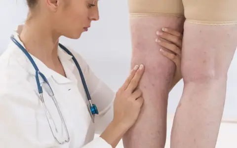 Lekarz bada nogi pacjentki z widocznymi żylakami. D-dimery a stan zapalny – ważny wskaźnik diagnostyczny.