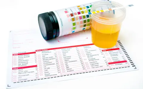 Pasek testowy do analizy moczu leży na zlewce z żółtym płynem. Obok znajduje się wydruk z wynikami badań, gdzie można odczytać m.in. ciężar właściwy moczu.