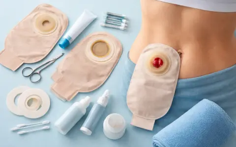 Urostomia: worek stomijny, akcesoria do pielęgnacji i fragment brzucha osoby.