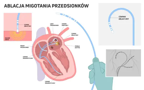 Ilustracja przedstawia schemat ablacji serca z cewnikami diagnostycznymi i ablacyjnymi w sercu.