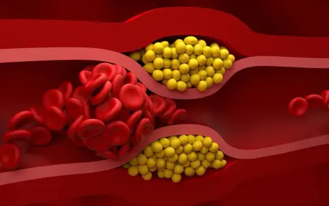 Zator w naczyniu krwionośnym: czerwone krwinki i żółte złogi. Badanie lipoproteiny pomoże ocenić ryzyko.