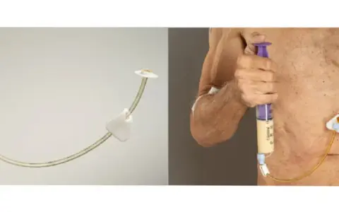 Gastrostomia endoskopowa (PEG) - przyrząd i zastosowanie.