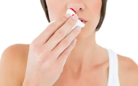 Kobieta przykłada chusteczkę do nosa, na której widać ślady krwi. Krwotok z nosa bywa uciążliwy.