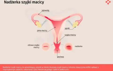 Ilustracja przedstawia budowę narządów rodnych kobiety z zaznaczoną nadżerką szyjki macicy.