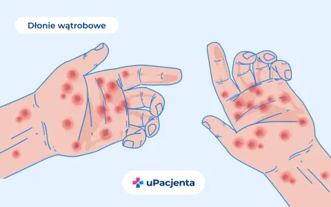 Dłonie z czerwonymi plamkami, ilustracja medyczna.