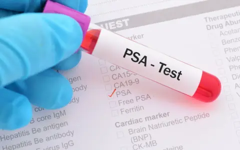 Probówka z krwią do badania PSA na tle formularza medycznego z zaznaczonym testem PSA.