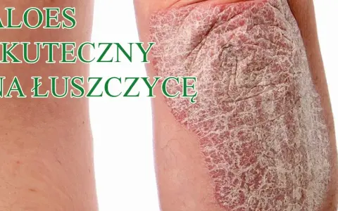 Czy jest nowy lek na łuszczycę? Odkryj najnowsze terapie i ich skuteczność