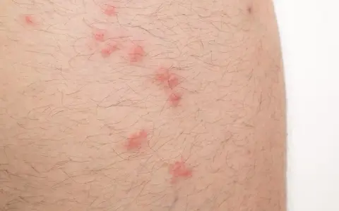 Skóra z licznymi czerwonymi, swędzącymi śladami, które wyglądają jak ugryzienie pchły.