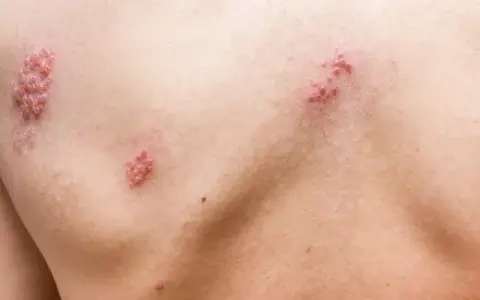 Jakie leki przeciwbólowe na półpasiec pomogą złagodzić ból?