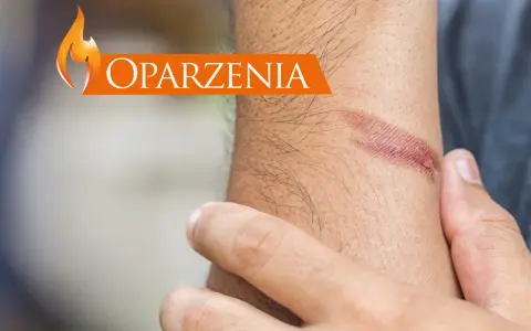 Dłoń z widocznym oparzeniem i napisem "Oparzenia".
