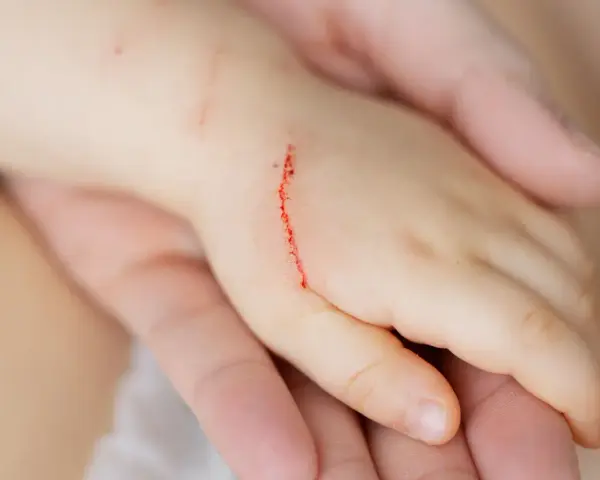 Dziecko ma zadrapanie na ręce, które może być objawem choroby kociego pazura.