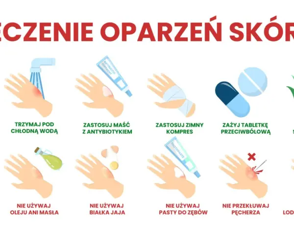 Ilustracja pokazuje leczenie oparzeń skóry: chłodna woda, maść z antybiotykiem, zimny kompres, tabletki przeciwbólowe, sok z aloesu. Unikaj masła, jajek, pasty do zębów, lodu.