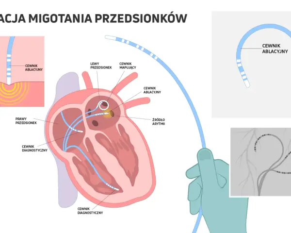 Ilustracja przedstawia schemat ablacji serca z cewnikami diagnostycznymi i ablacyjnymi w sercu.