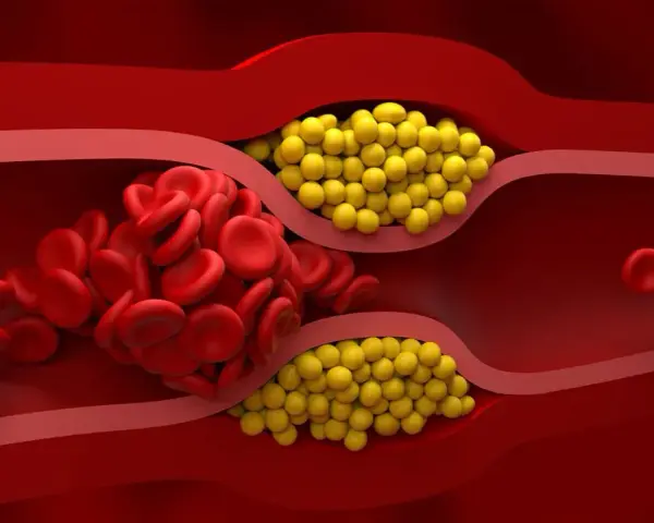 Zator w naczyniu krwionośnym: czerwone krwinki i żółte złogi. Badanie lipoproteiny pomoże ocenić ryzyko.