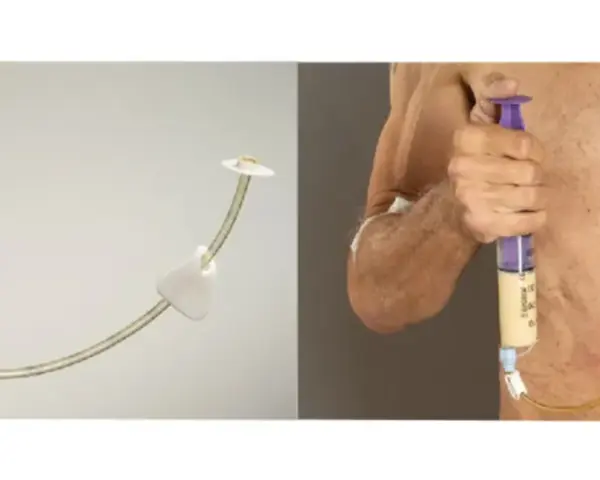 Gastrostomia endoskopowa (PEG) - przyrząd i zastosowanie.