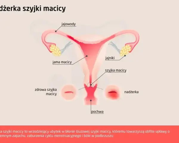 Ilustracja przedstawia budowę narządów rodnych kobiety z zaznaczoną nadżerką szyjki macicy.
