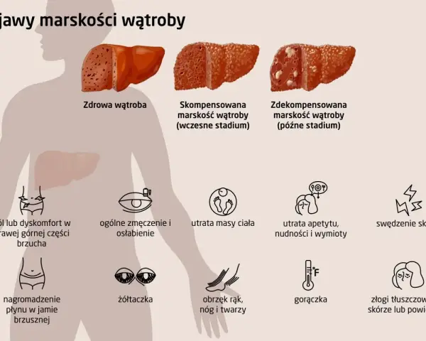 Ilustracja przedstawia objawy marskości wątroby: ból brzucha, zmęczenie, utratę masy ciała, żółtaczkę, obrzęki, gorączkę i zmiany skórne.