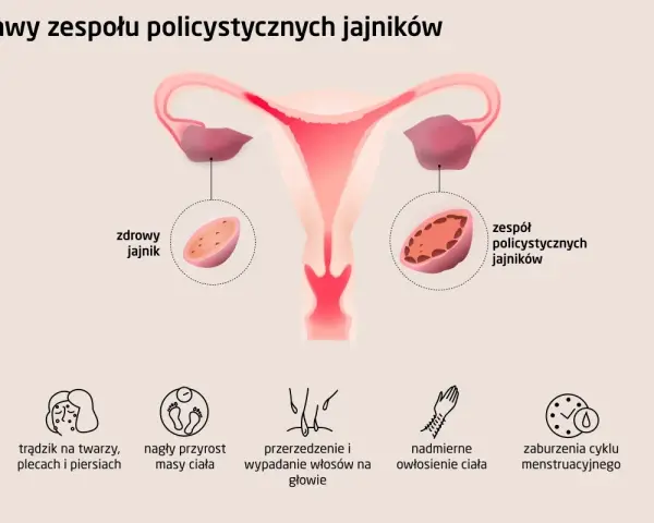 Ilustracja pokazuje budowę macicy i jajników, porównując zdrowy jajnik z tymi w zespole PCOS. Wymienia też typowe pcos objawy: trądzik, przyrost masy ciała, wypadanie włosów, nadmierne owłosienie i zaburzenia cyklu.