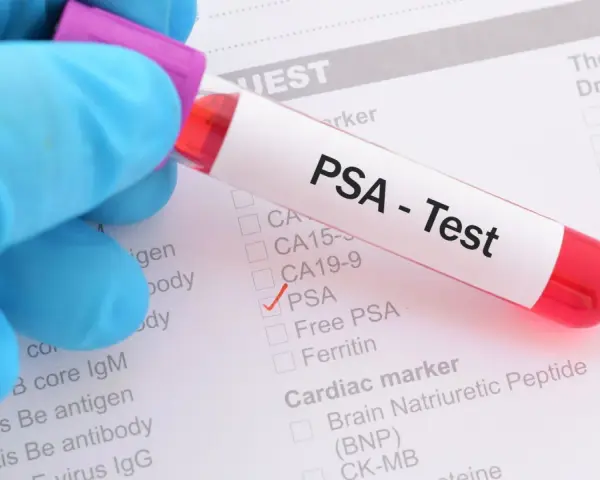Probówka z krwią do badania PSA na tle formularza medycznego z zaznaczonym testem PSA.