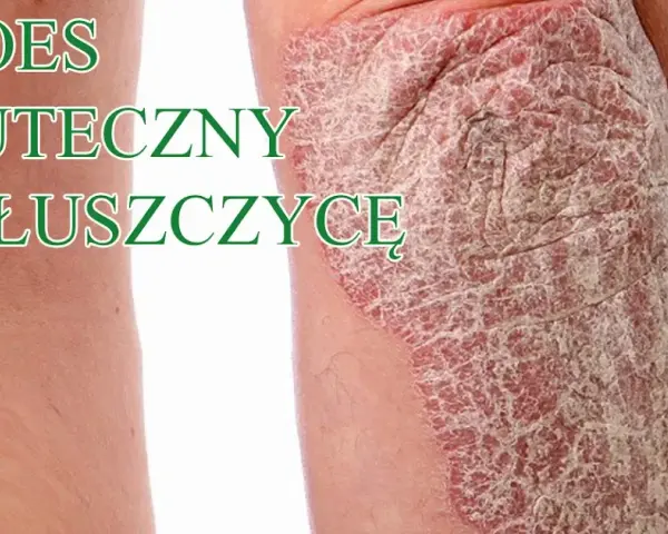 Czy jest nowy lek na łuszczycę? Odkryj najnowsze terapie i ich skuteczność