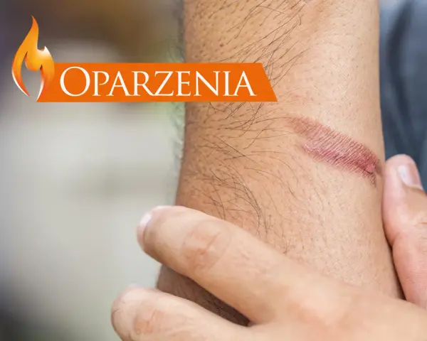 Dłoń z widocznym oparzeniem i napisem "Oparzenia".